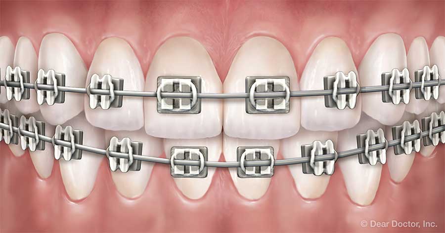 Metal braces.