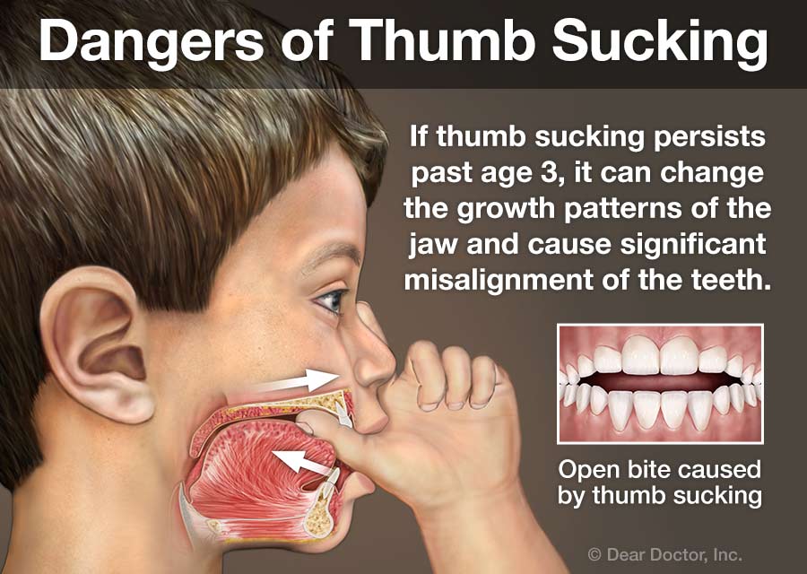 Dangers of Thumb Sucking.